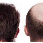 Some of the Problems Solved by Hair Transplant